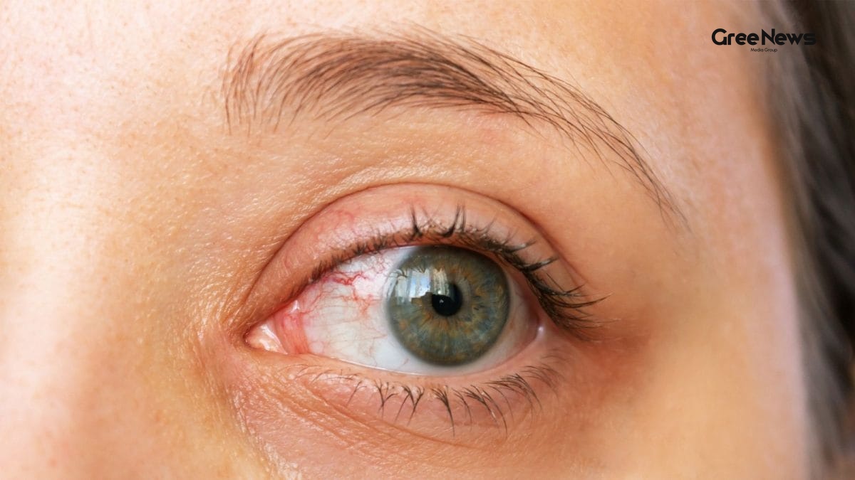 Eye Trouble? My Journey From Simple Redness to Spotting Real Warning Signs