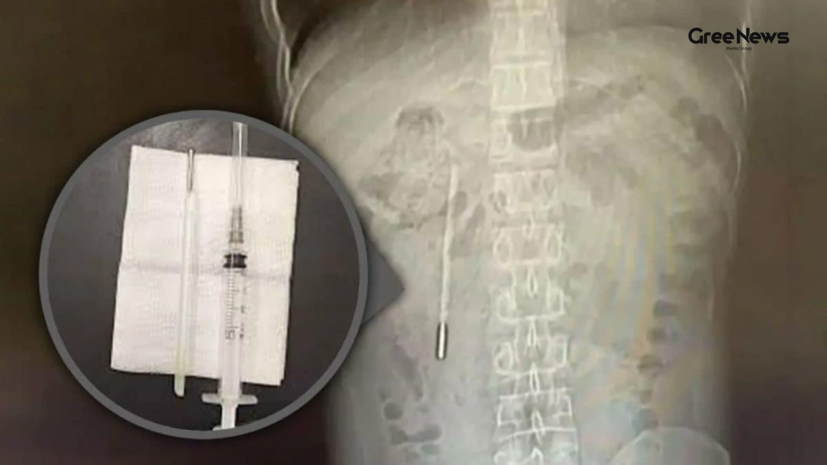 Swallowed Thermometer Found After 20 Years: A Bizarre Medical Tale That Shocked Many